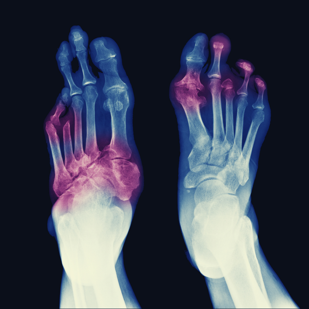 Can Neuropathy In Feet Be Reversed